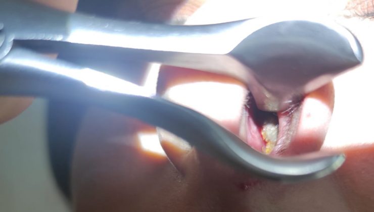 Diyarbakır’da bir hastanın burnundan taş çıktı