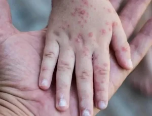 Endonezya'da kızamık salgını: 17 kişi hayatını kaybetti