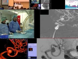 Malatya’dan dünyaya tıbbi başarı: Beyin baloncuğu tedavisi canlı yayında yapıldı