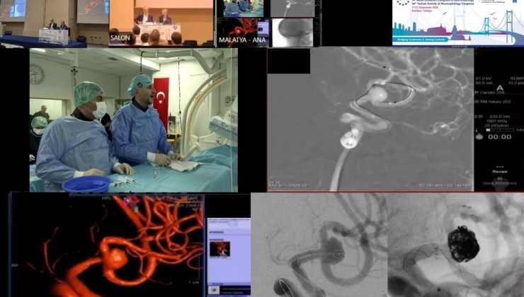 Malatya’dan dünyaya tıbbi başarı: Beyin baloncuğu tedavisi canlı yayında yapıldı